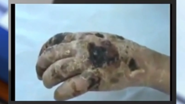 Flesh-eating Russian opiate drug called ‘krokodil’ arrives in Arizona