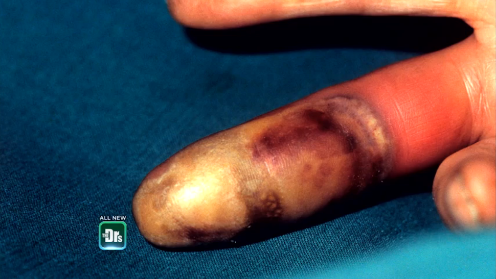 Flesh-Eating Drug Krokodil Is Now Attacking Chicago Suburbs